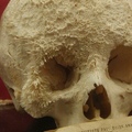 bone cancer on the skull