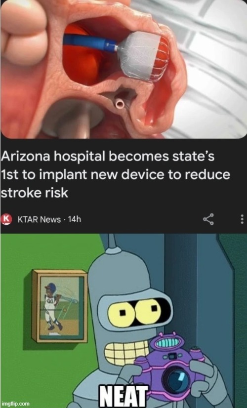 Arizona hospoital beomes state's 1st to implant new device to reduce stroke risk - meme