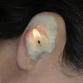 Ear wax candle