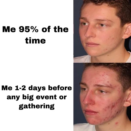 Acne before an event - meme