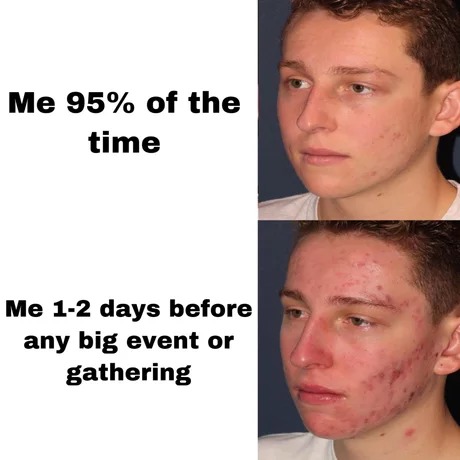 Acne before an event - meme