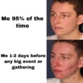 Acne before an event