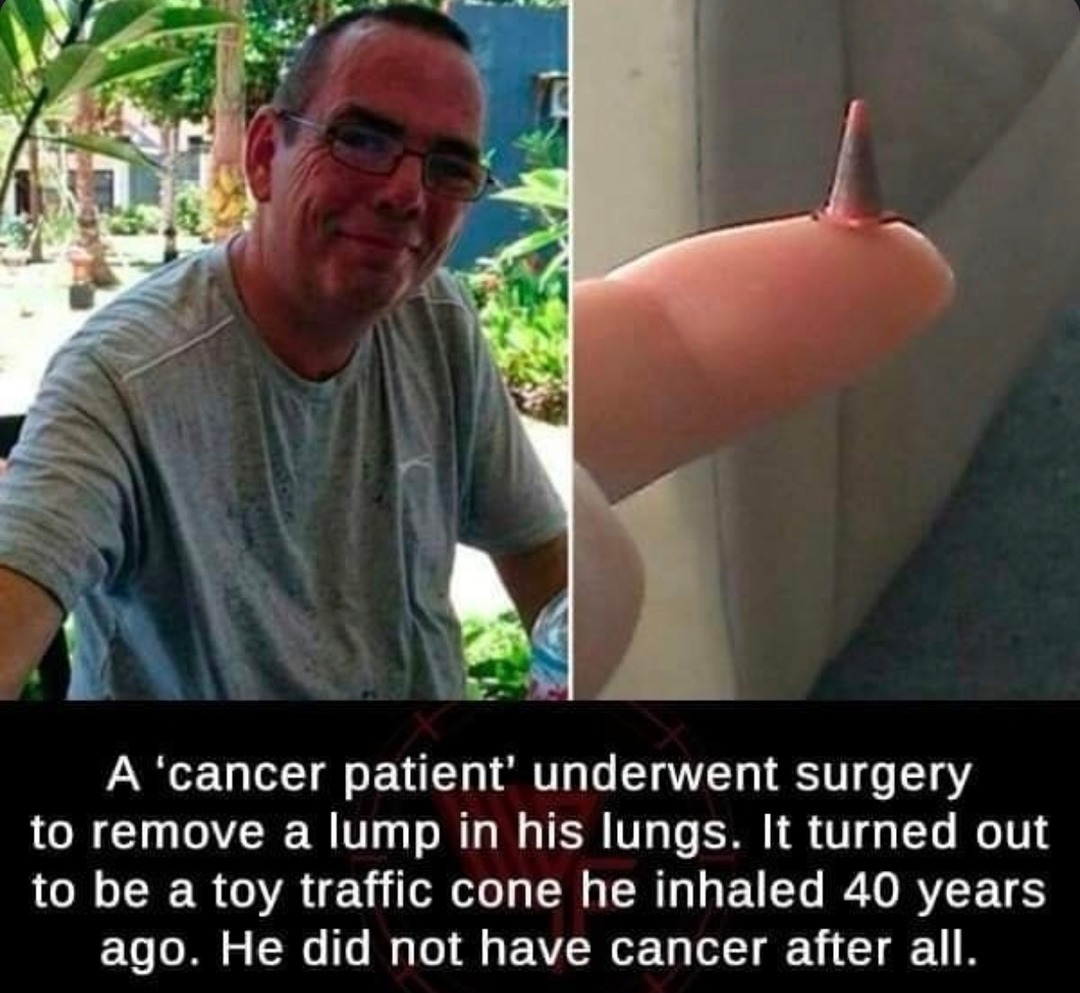 ﻿A ‘cancer patient’ underwent surgery to remove a lump in his lungs: It turned out to be a traffic cone he inhaled 40 years ago. He did not have cancer after all: toy
