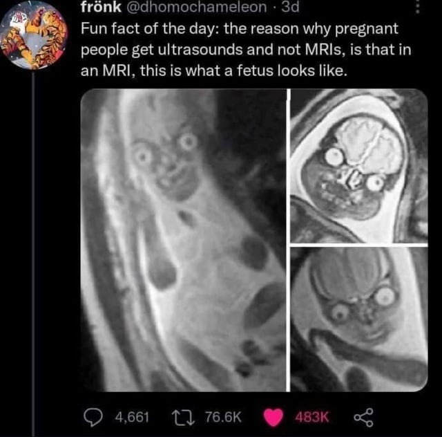 MRIs really said: nightmare fuel unlocked - meme