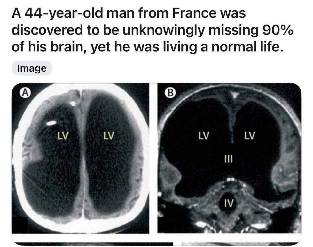 Dude missing 90% of his brain but still more functional than me - meme