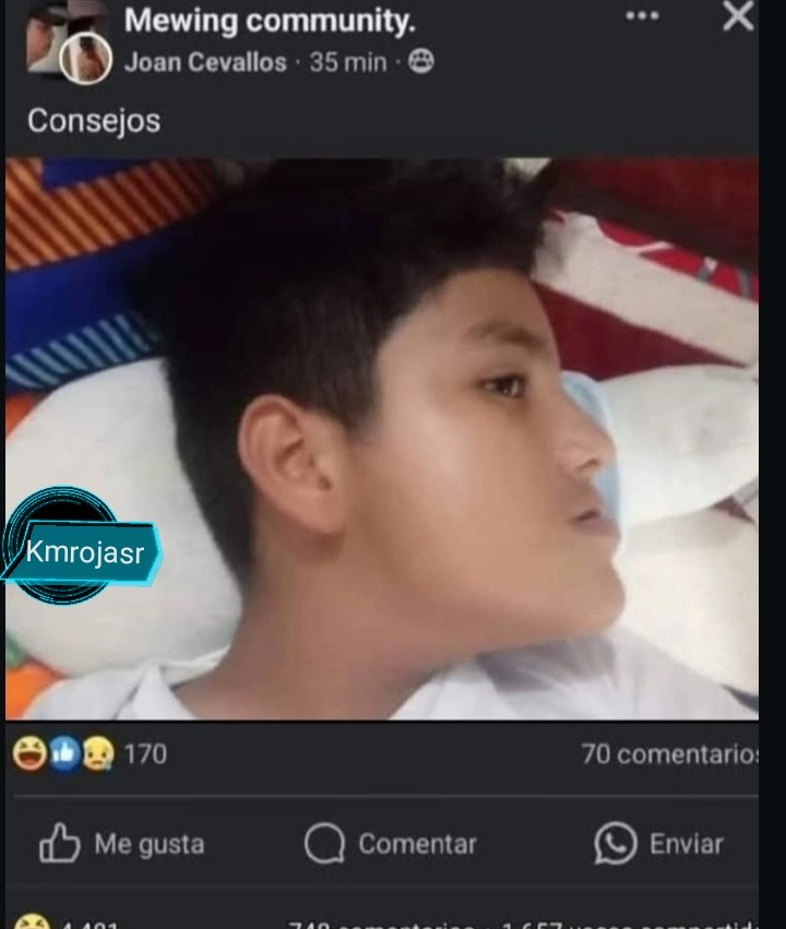 Aun existe el mewing - meme