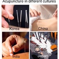 acupuncture in different cultures